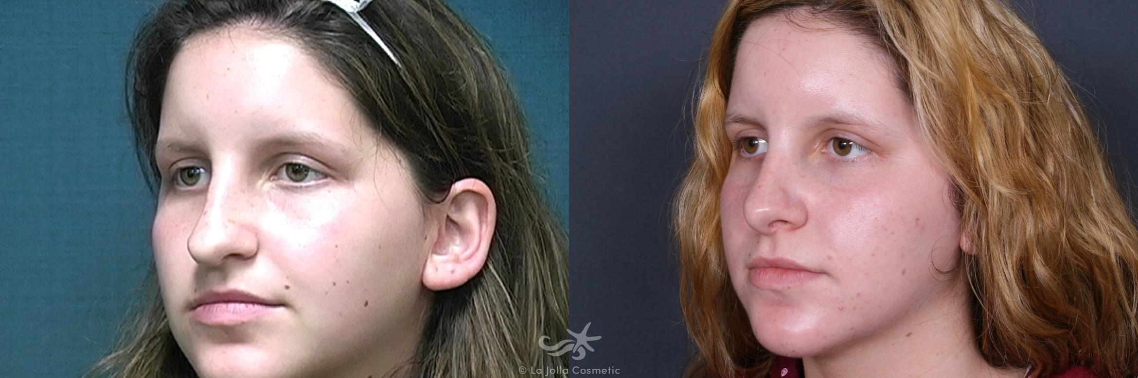 Before & After Rhinoplasty Result 530 Left Oblique View in San Diego, CA