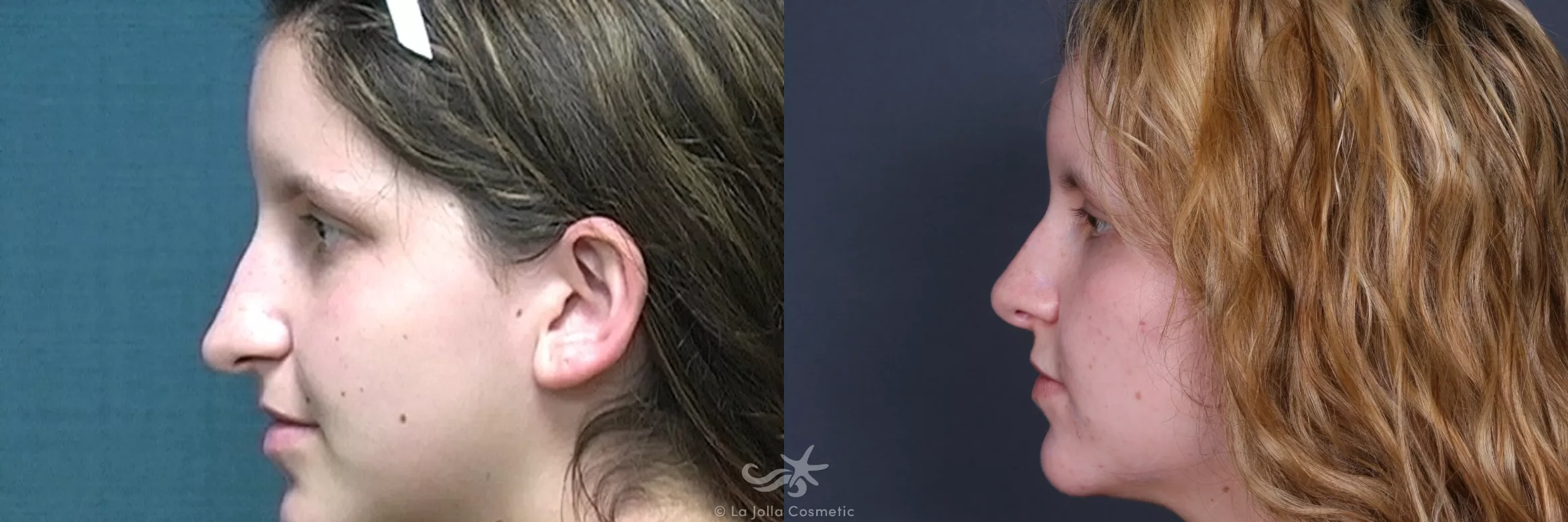 Before & After Rhinoplasty Result 530 Left Side View in San Diego, CA
