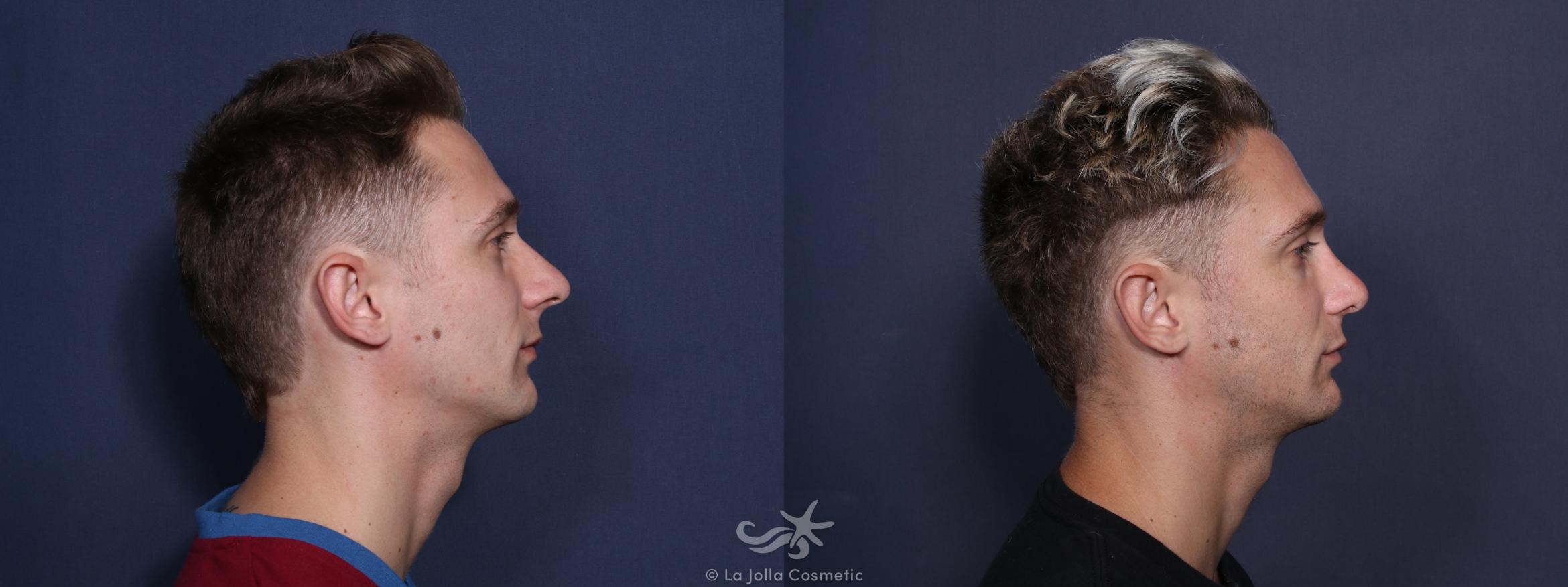 Before & After Rhinoplasty Result 58 Right Side View in San Diego, CA