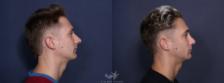Before & After Rhinoplasty Result 58 Right Side View in San Diego, Carlsbad, CA