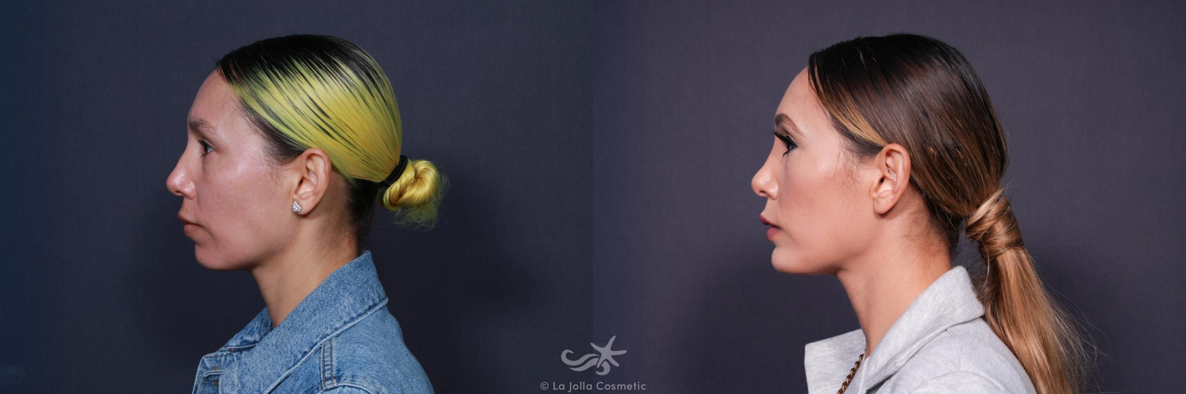 Before & After Rhinoplasty Result 604 Left Side View in San Diego, CA