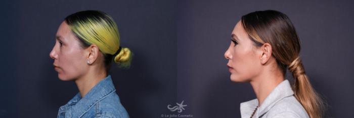 Before & After Rhinoplasty Result 604 Left Side View in San Diego, Carlsbad, CA