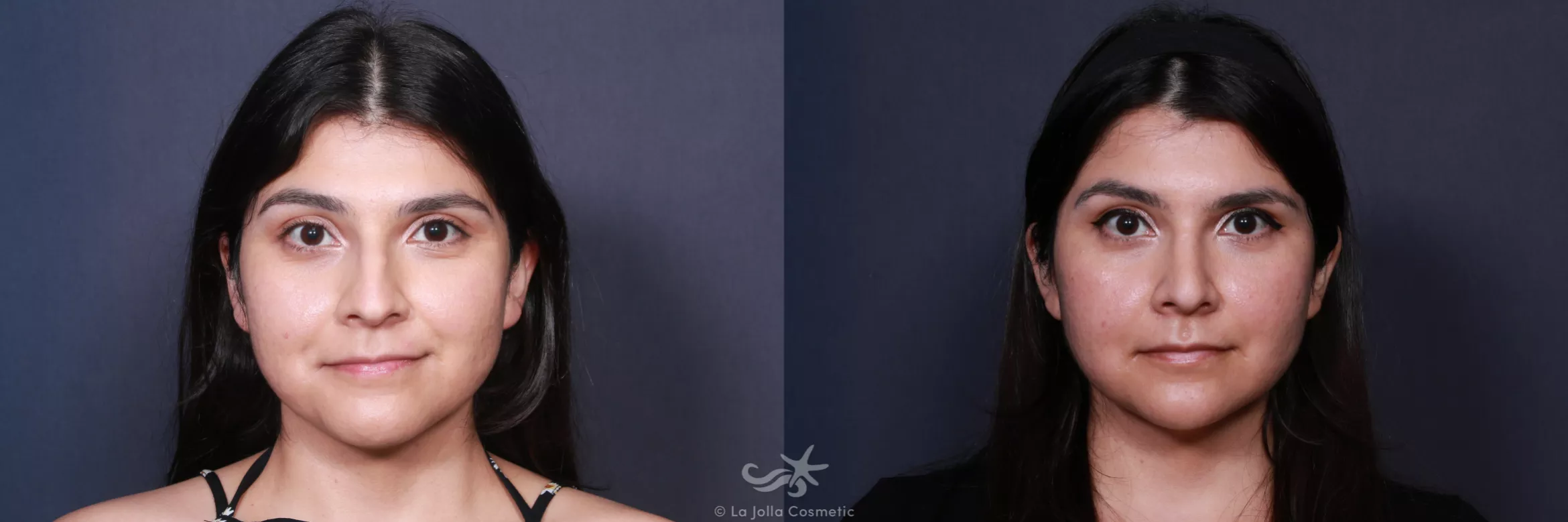 Before & After Rhinoplasty Result 62 Front View in San Diego, CA