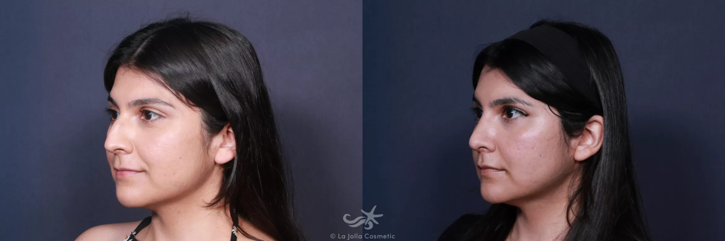 Before & After Rhinoplasty Result 62 Left Oblique View in San Diego, CA