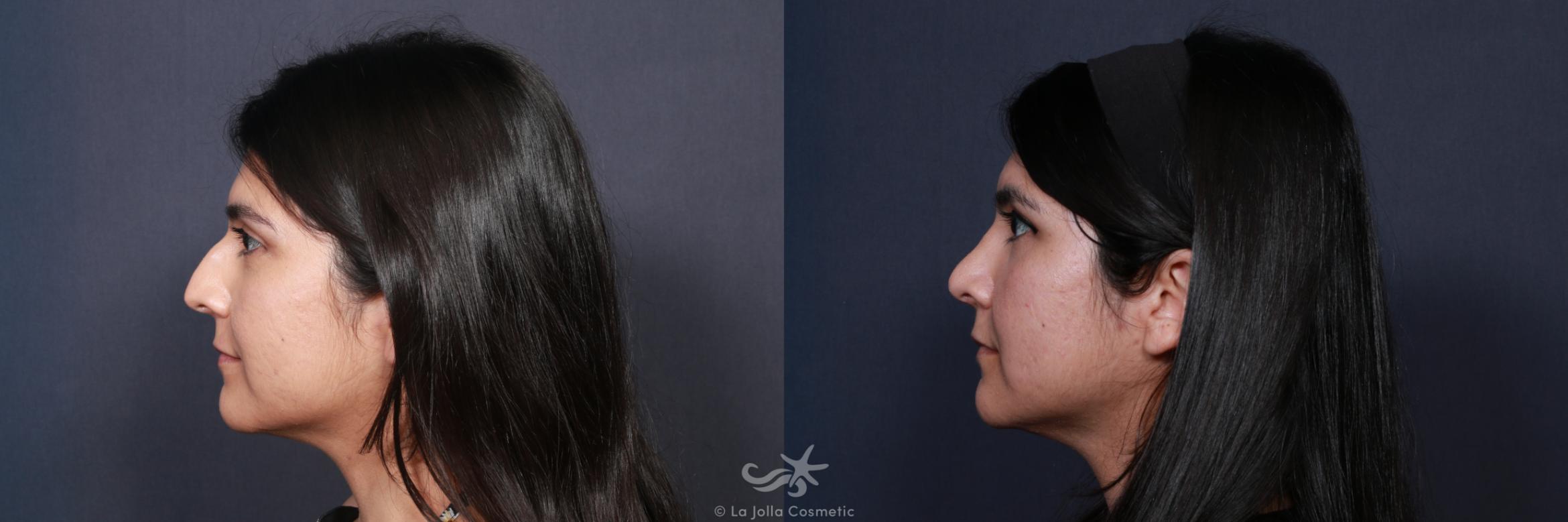 Before & After Rhinoplasty Result 62 Left Side View in San Diego, CA