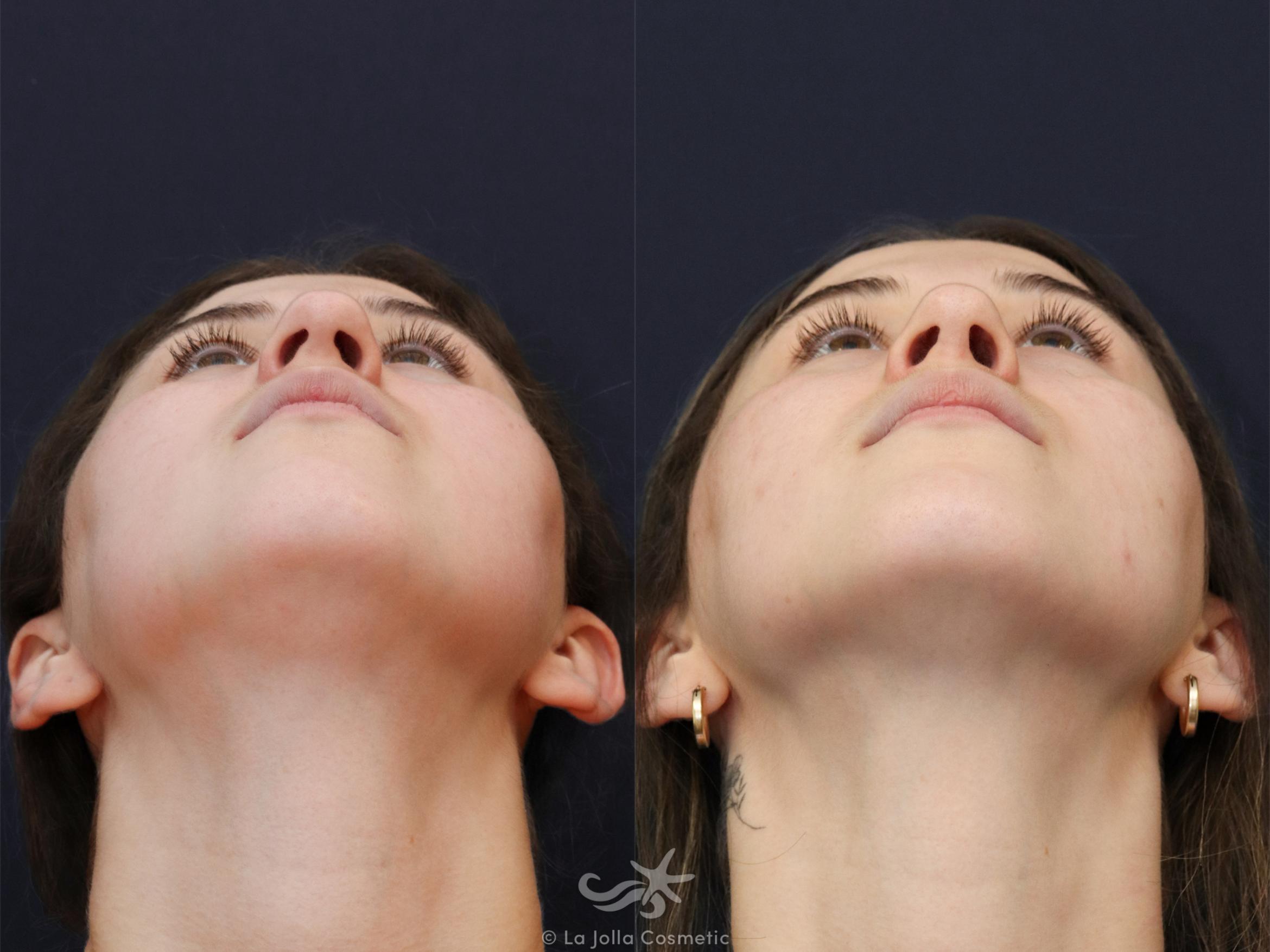 Before & After Rhinoplasty Result 625 Basal View in San Diego, CA