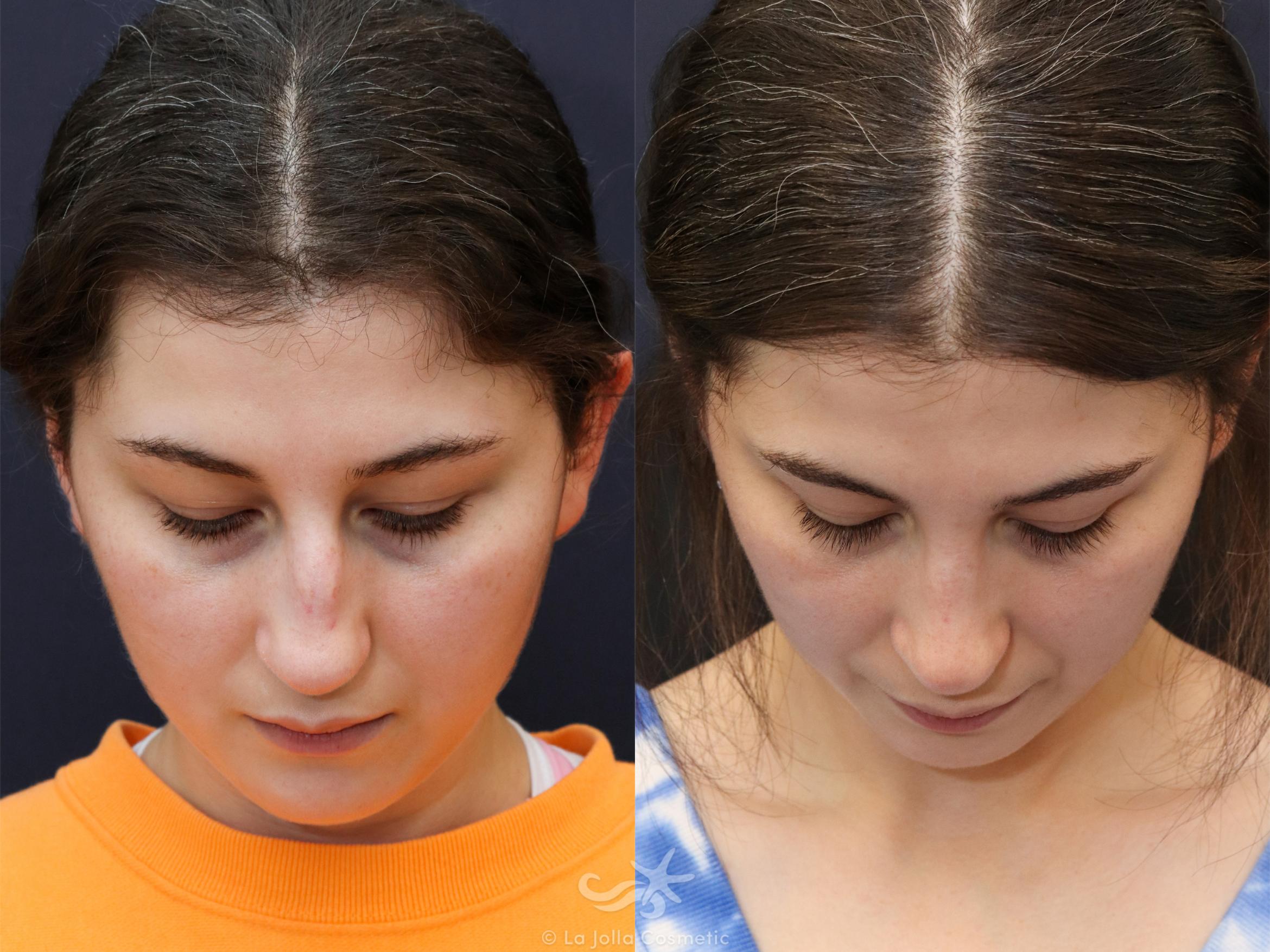 Before & After Rhinoplasty Result 625 Cephalic View in San Diego, CA