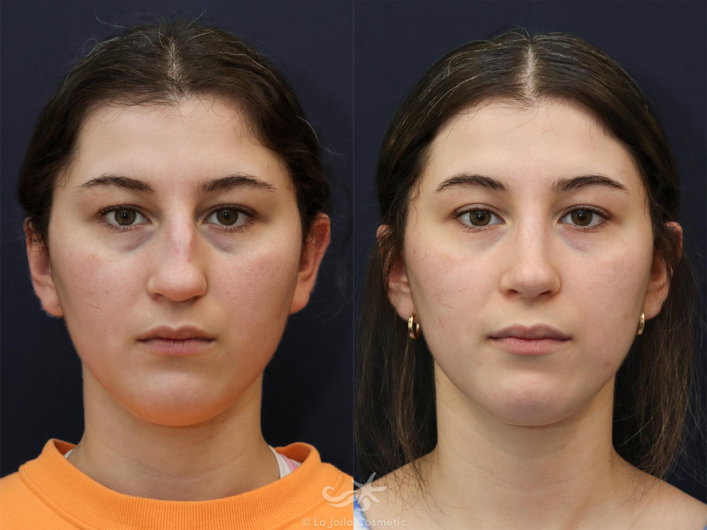Before & After Rhinoplasty Result 625 Front View in San Diego, CA