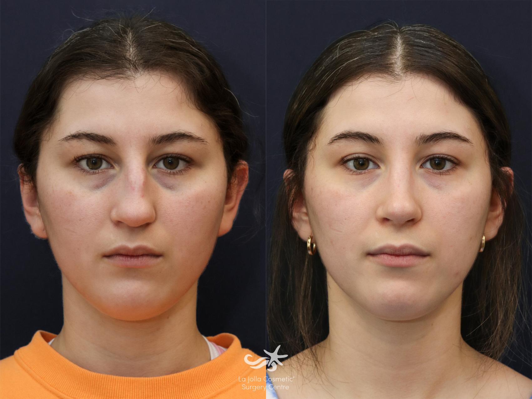 Before & After Rhinoplasty Result 625 Front View in San Diego, CA