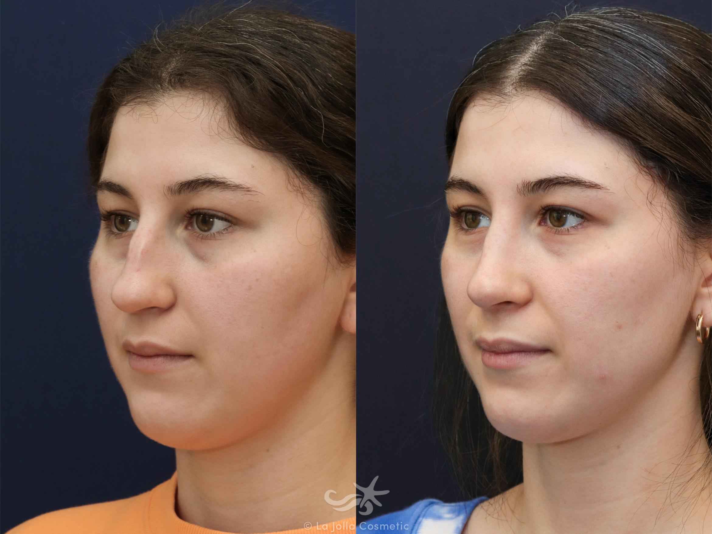 Before & After Rhinoplasty Result 625 Left Oblique View in San Diego, CA