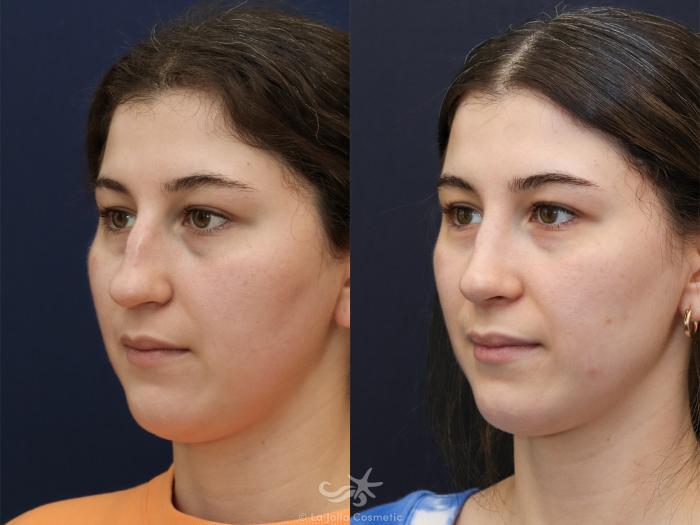 Before & After Rhinoplasty Result 625 Left Oblique View in San Diego, Carlsbad, CA