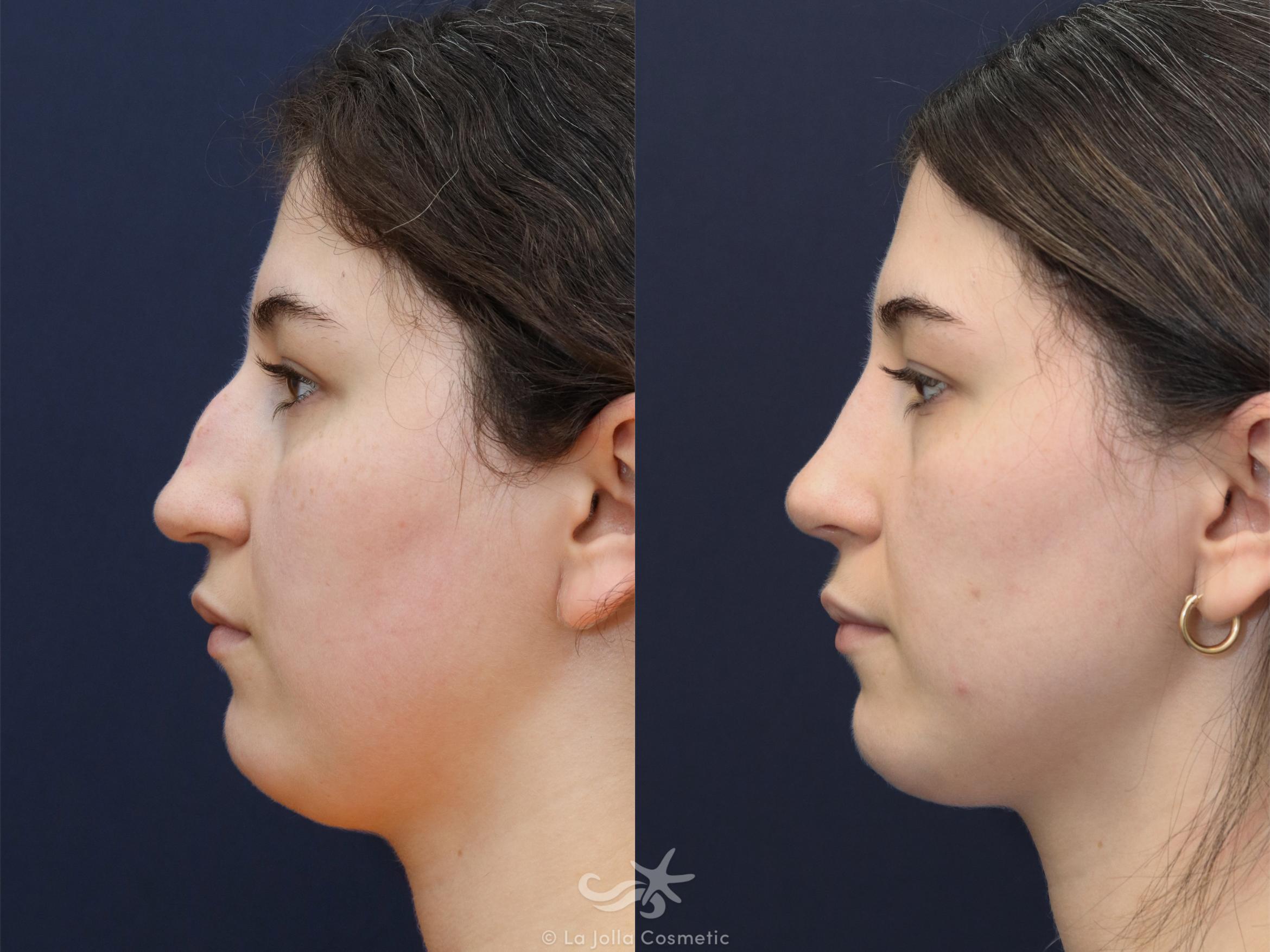 Before & After Rhinoplasty Result 625 Left Side View in San Diego, CA