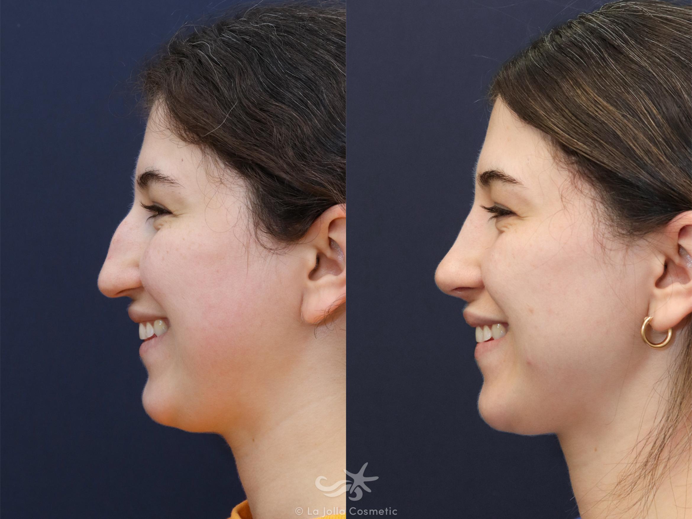 Before & After Rhinoplasty Result 625 Left Side Smiling View in San Diego, CA