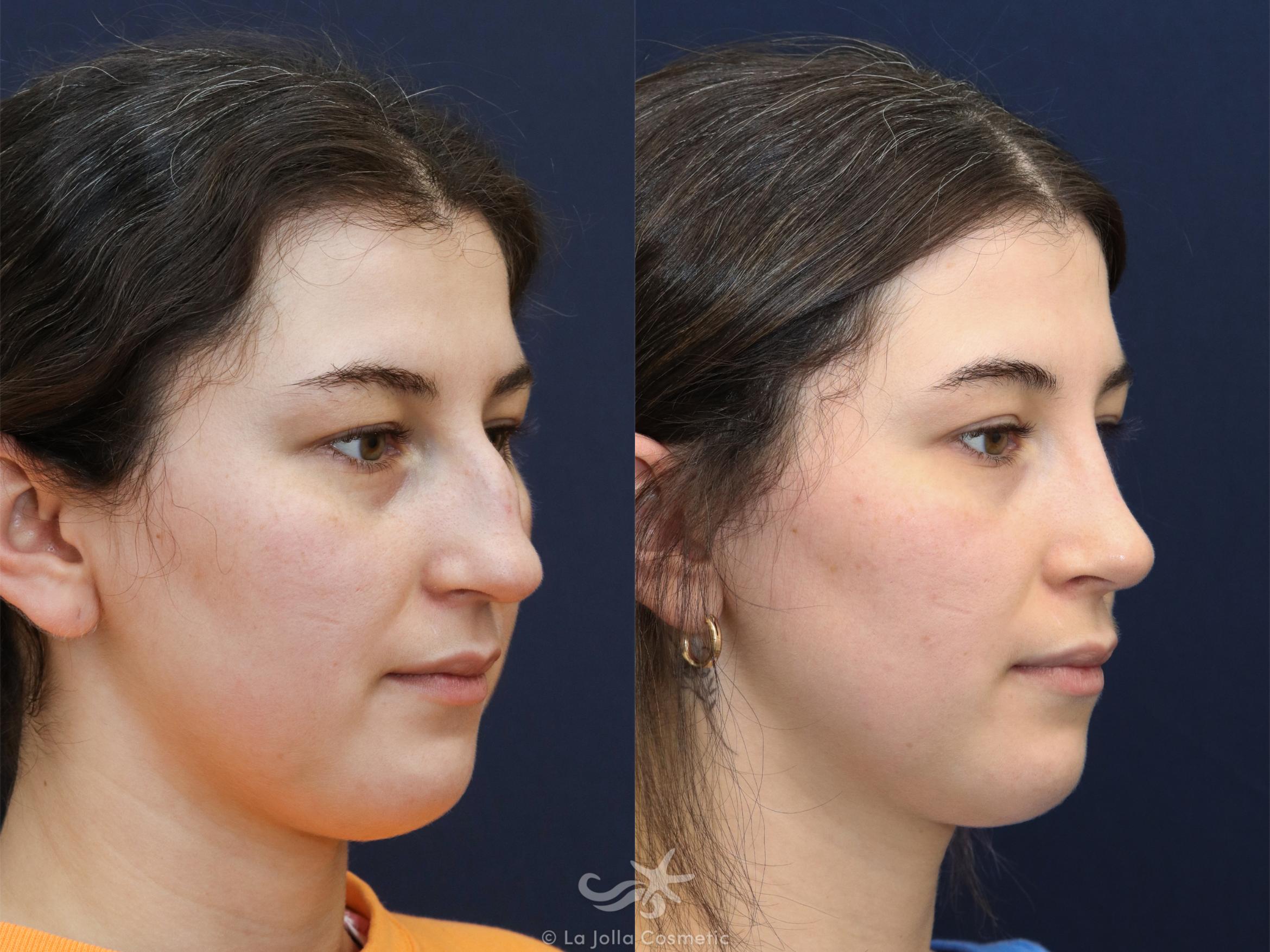Before & After Rhinoplasty Result 625 Right Oblique View in San Diego, CA