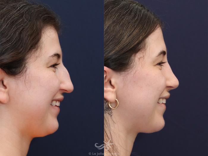 Before & After Rhinoplasty Result 625 Right Side Smiling View in San Diego, Carlsbad, CA