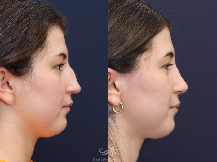 Before & After Rhinoplasty Result 625 Right Side View in San Diego, Carlsbad, CA