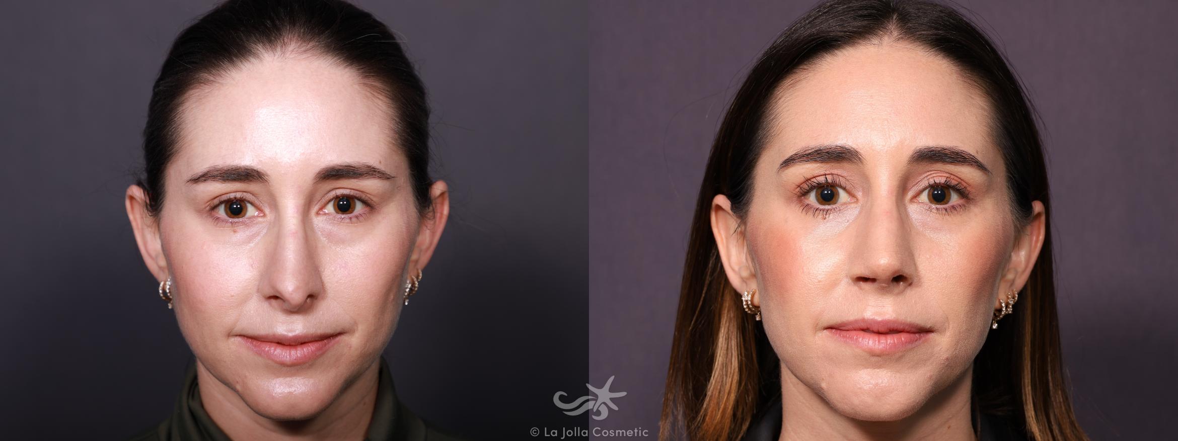 Before & After Rhinoplasty Result 657 Front View in San Diego, CA