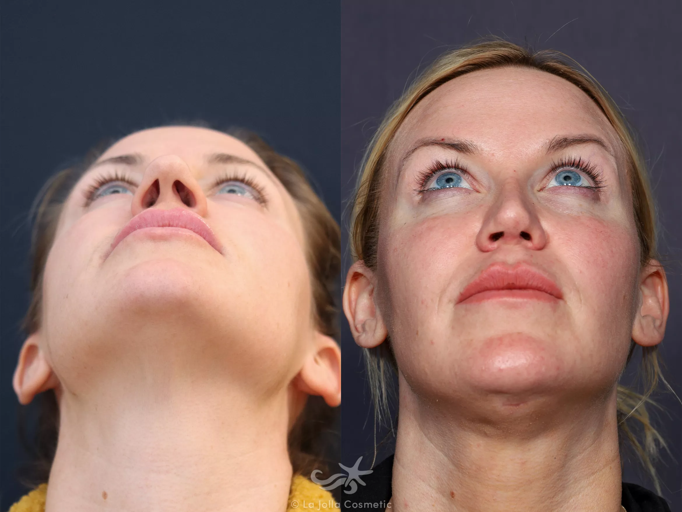 Before & After Rhinoplasty Result 676 Basal View in San Diego, CA