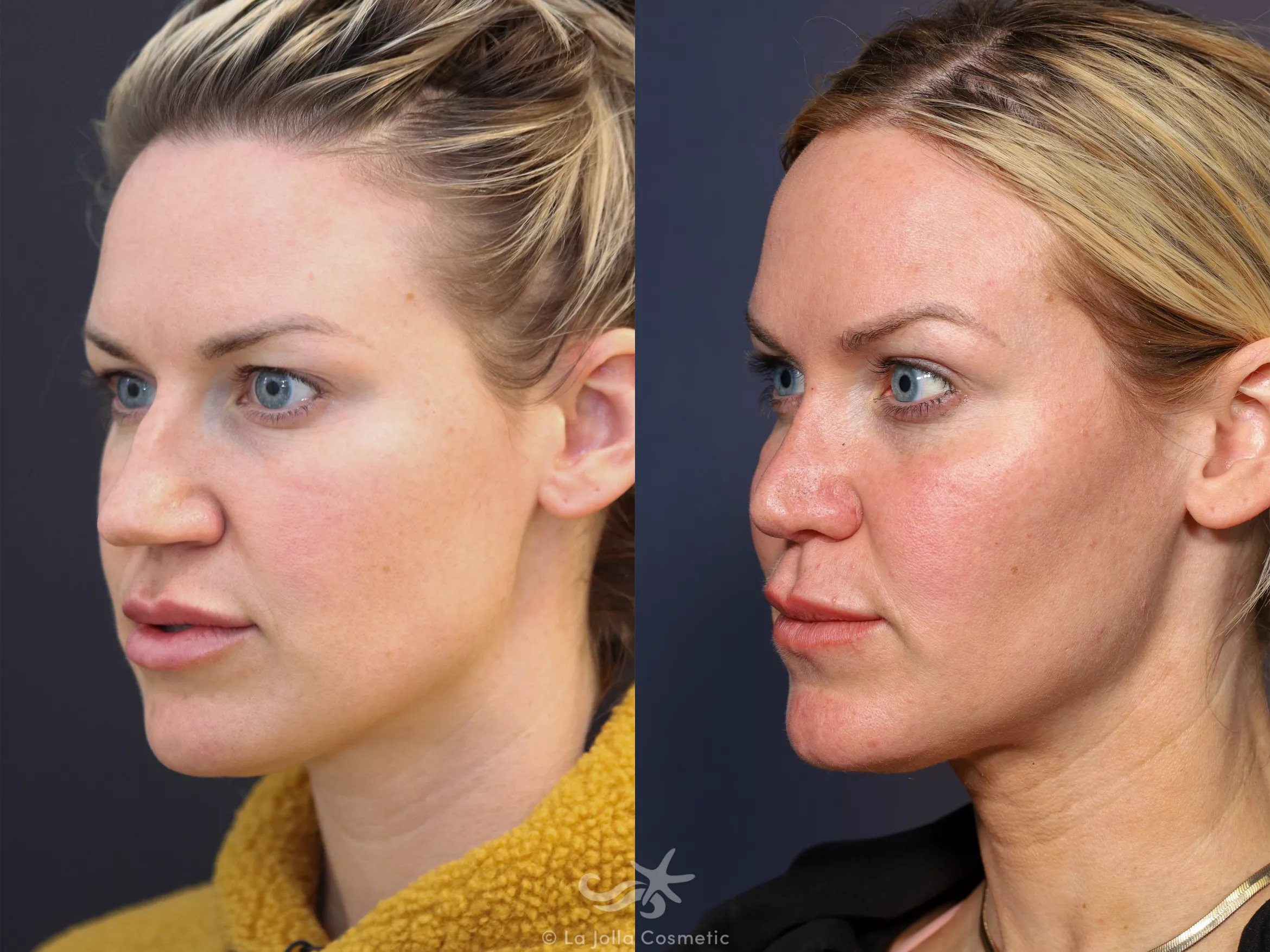 Before & After Rhinoplasty Result 676 Left Oblique View in San Diego, CA