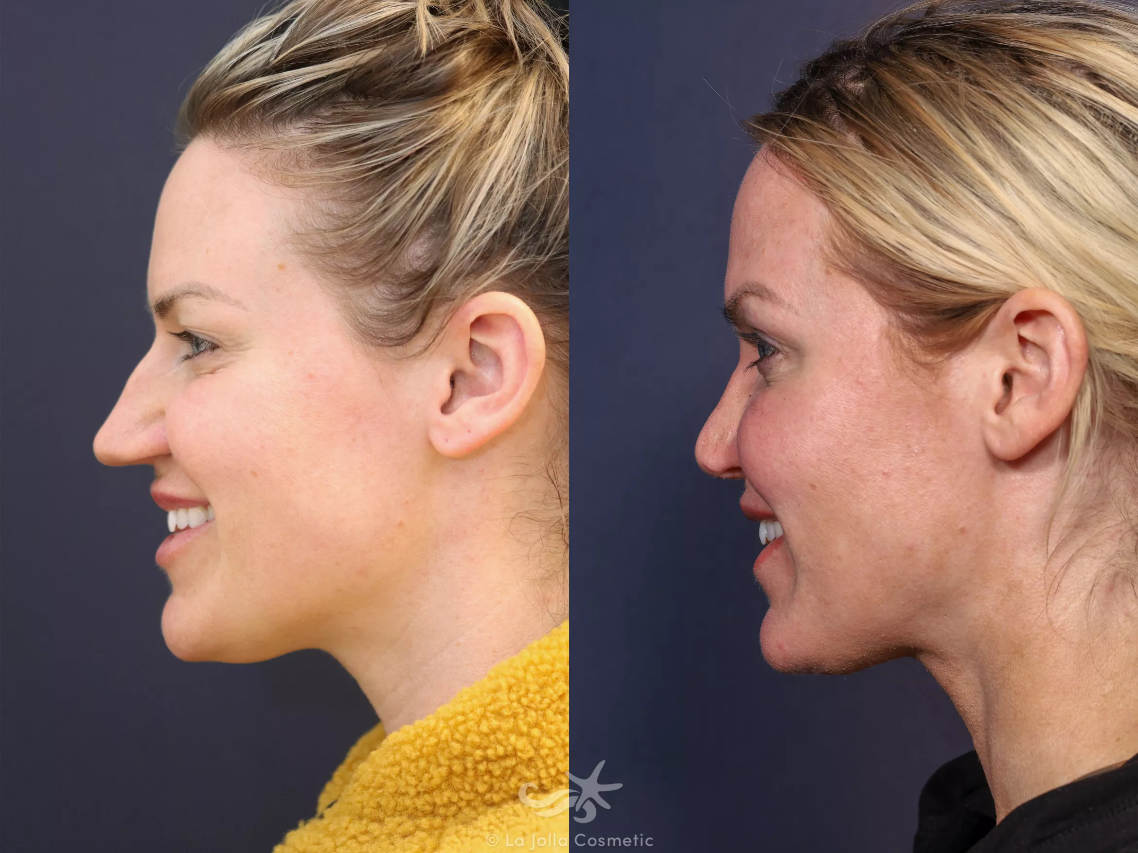 Before & After Rhinoplasty Result 676 Left side smiling View in San Diego, CA