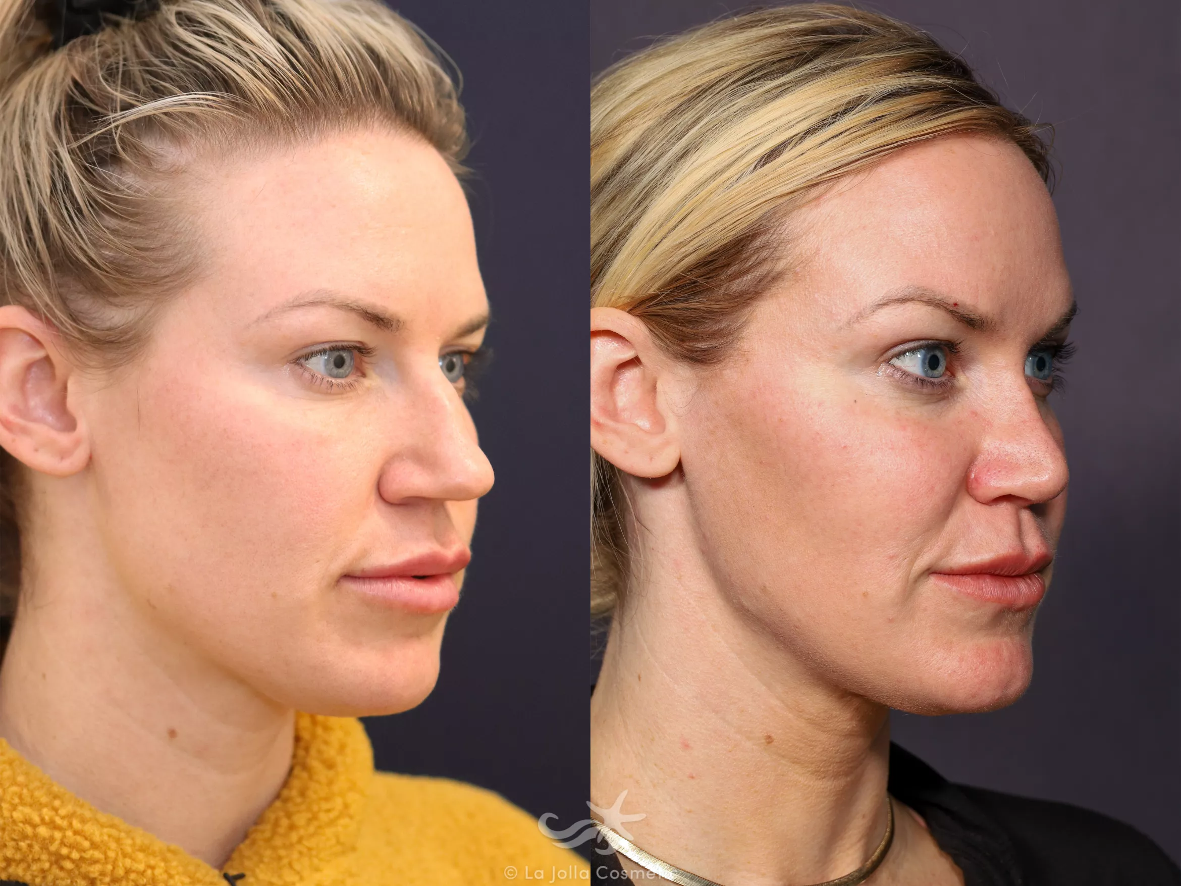 Before & After Rhinoplasty Result 676 Right Oblique View in San Diego, CA