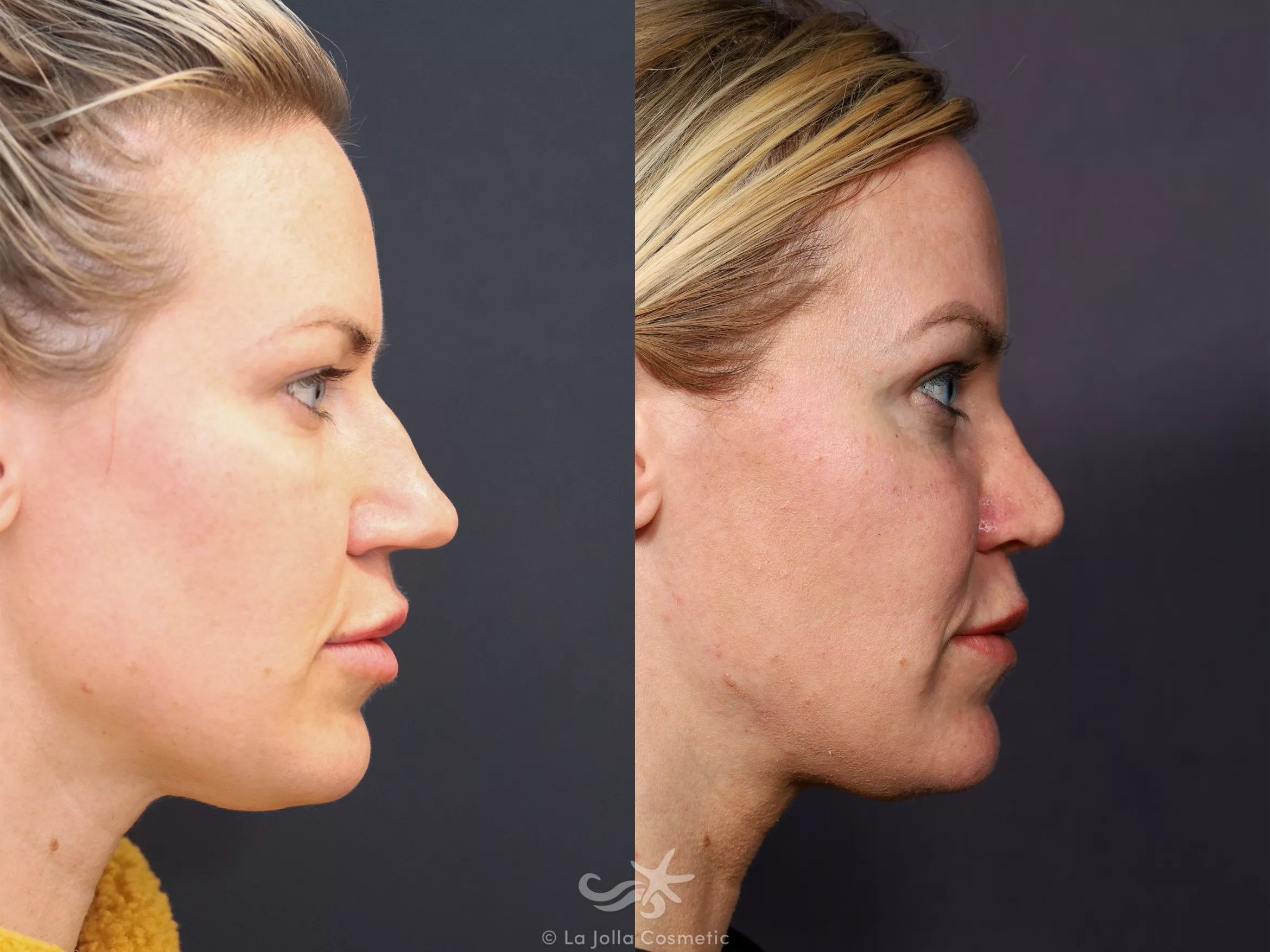 Before & After Rhinoplasty Result 676 Right Side View in San Diego, CA