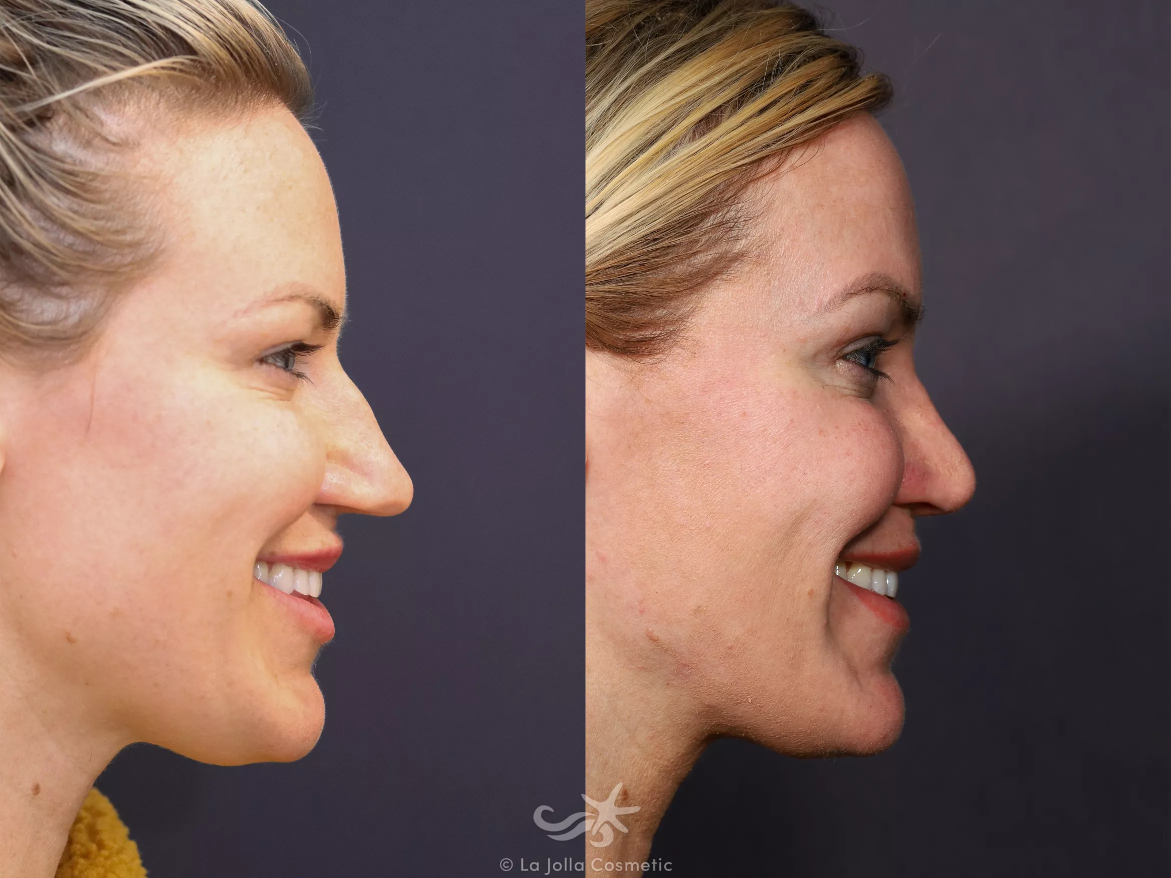 Before & After Rhinoplasty Result 676 Right side smiling View in San Diego, CA