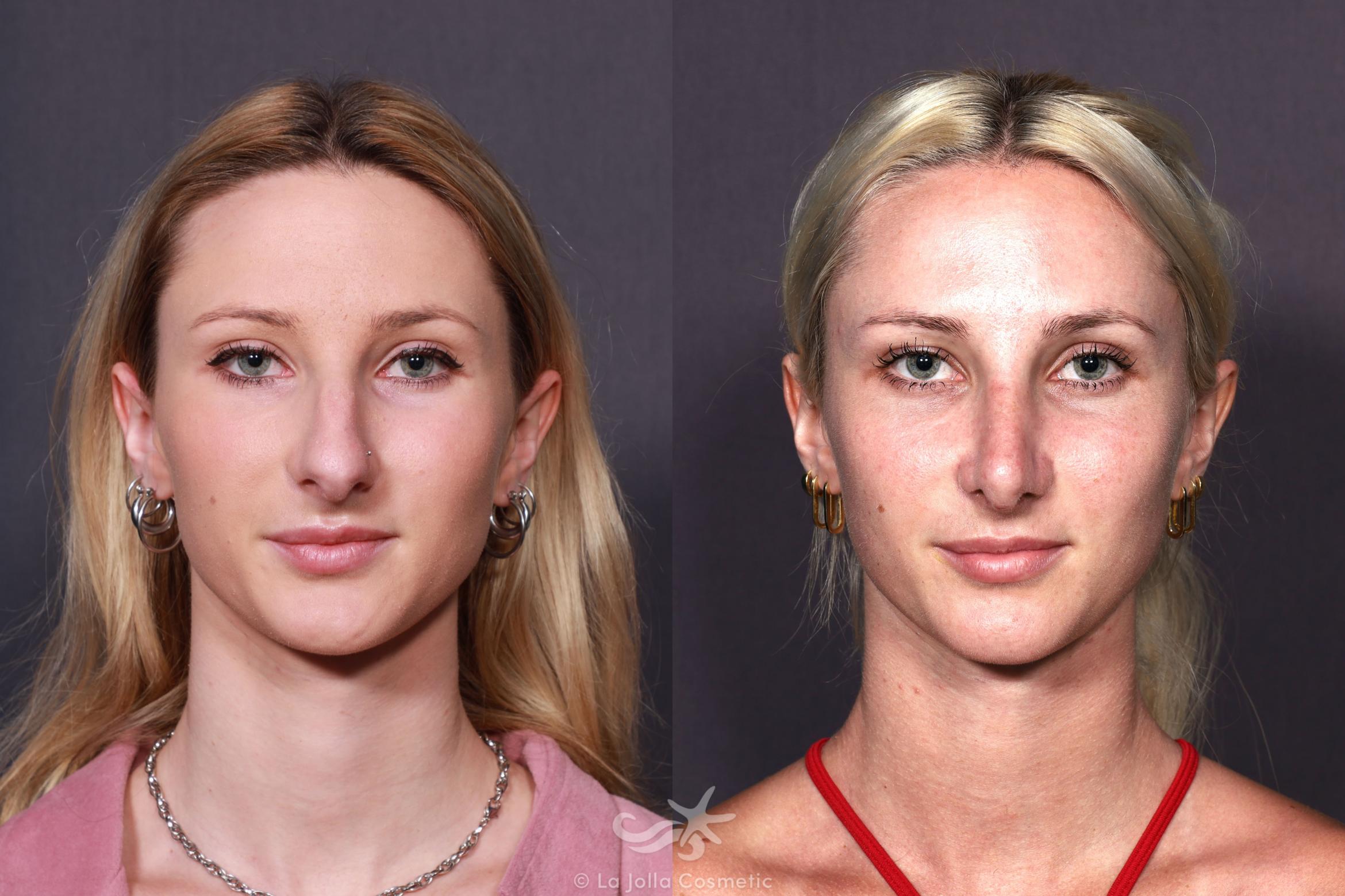 Before & After Rhinoplasty Result 687 Front View in San Diego, CA