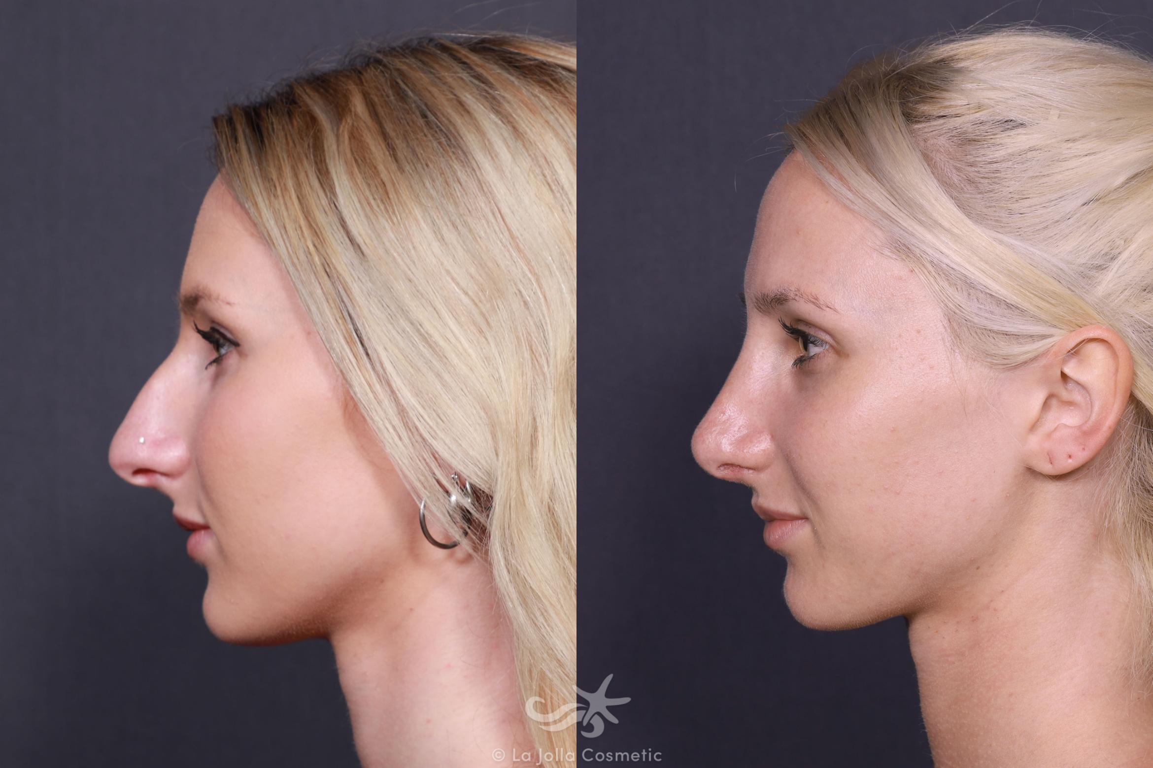 Before & After Rhinoplasty Result 687 Left Side View in San Diego, CA