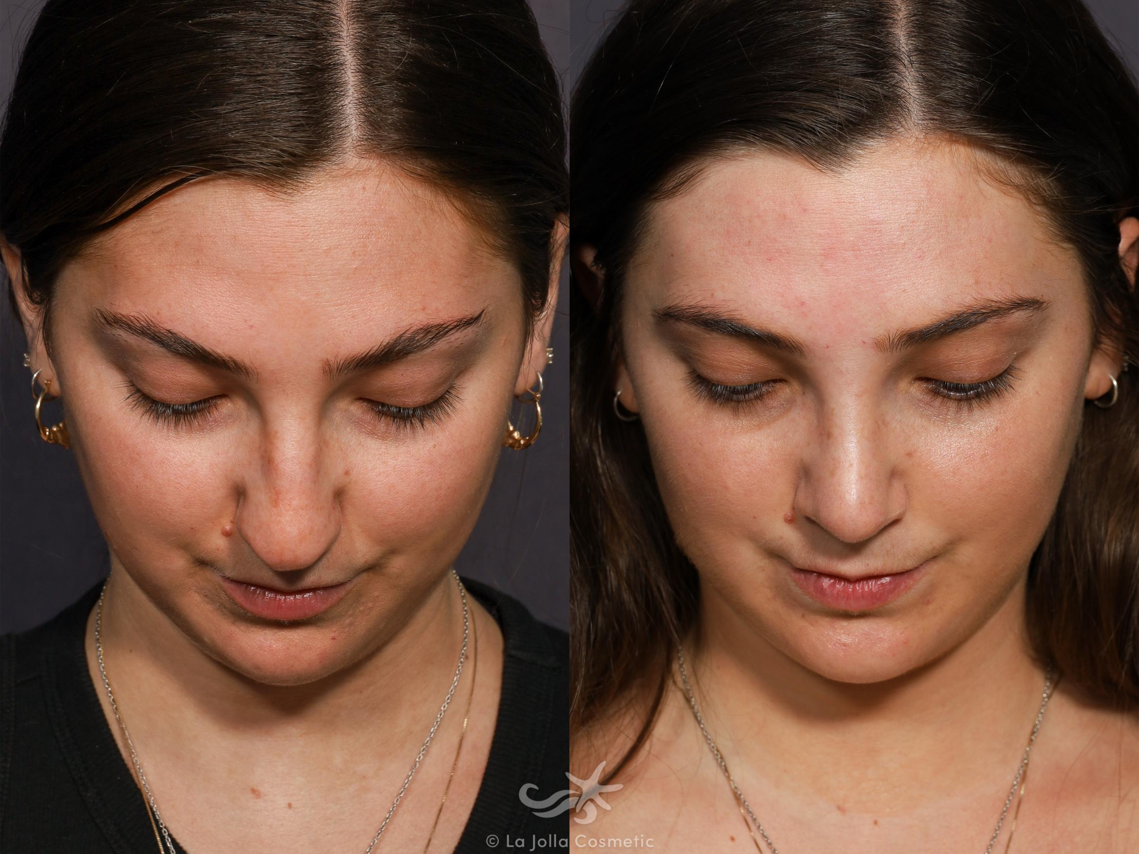 Before & After Rhinoplasty Result 712 Bird's Eye View in San Diego, CA