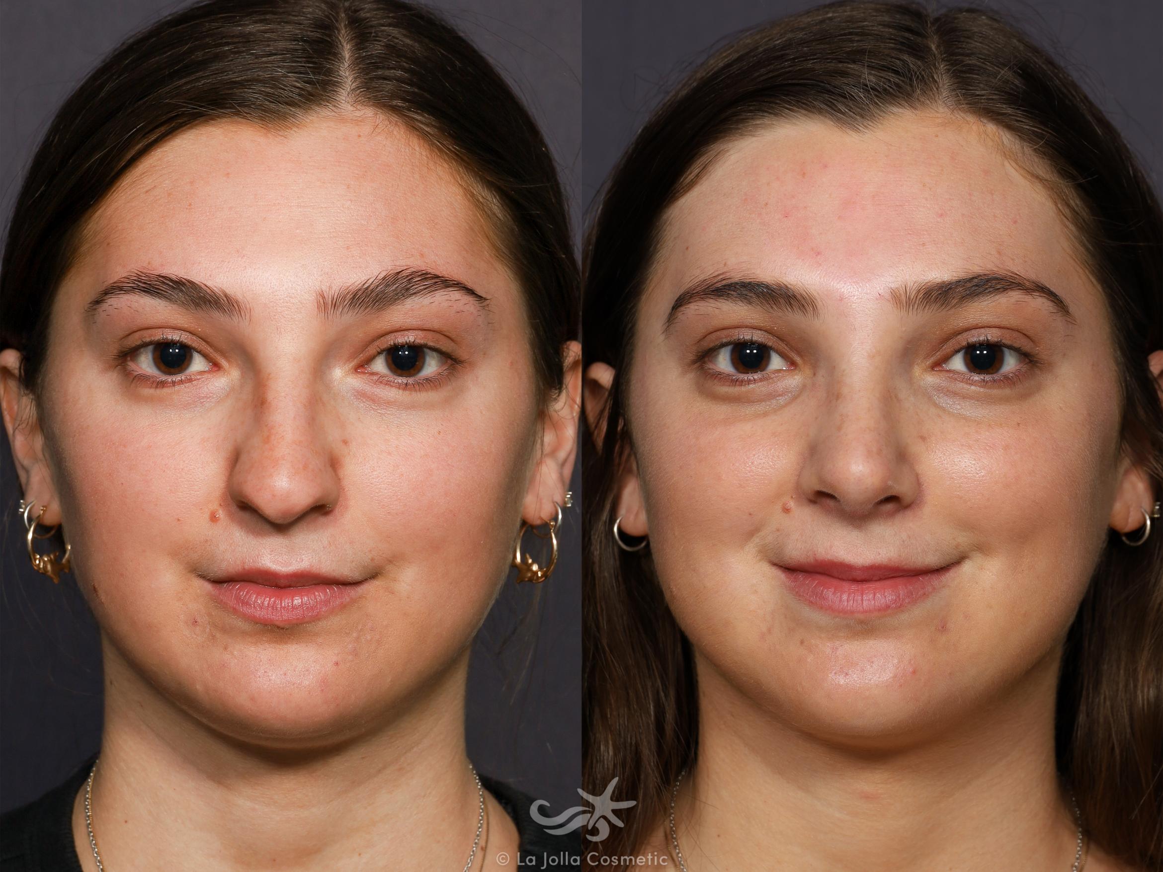 Before & After Rhinoplasty Result 712 Front View in San Diego, CA