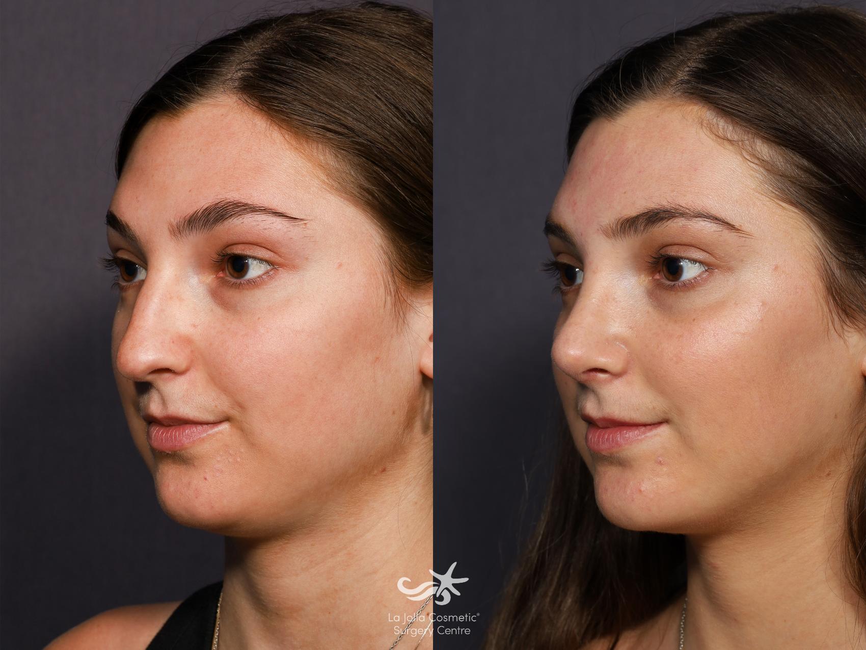 Rhinoplasty Before and After Pictures Result 712 | San Diego, CA | La ...