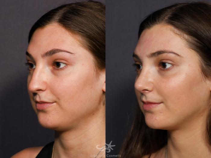 Before & After Rhinoplasty Result 712 Left Oblique View in San Diego, Carlsbad, CA