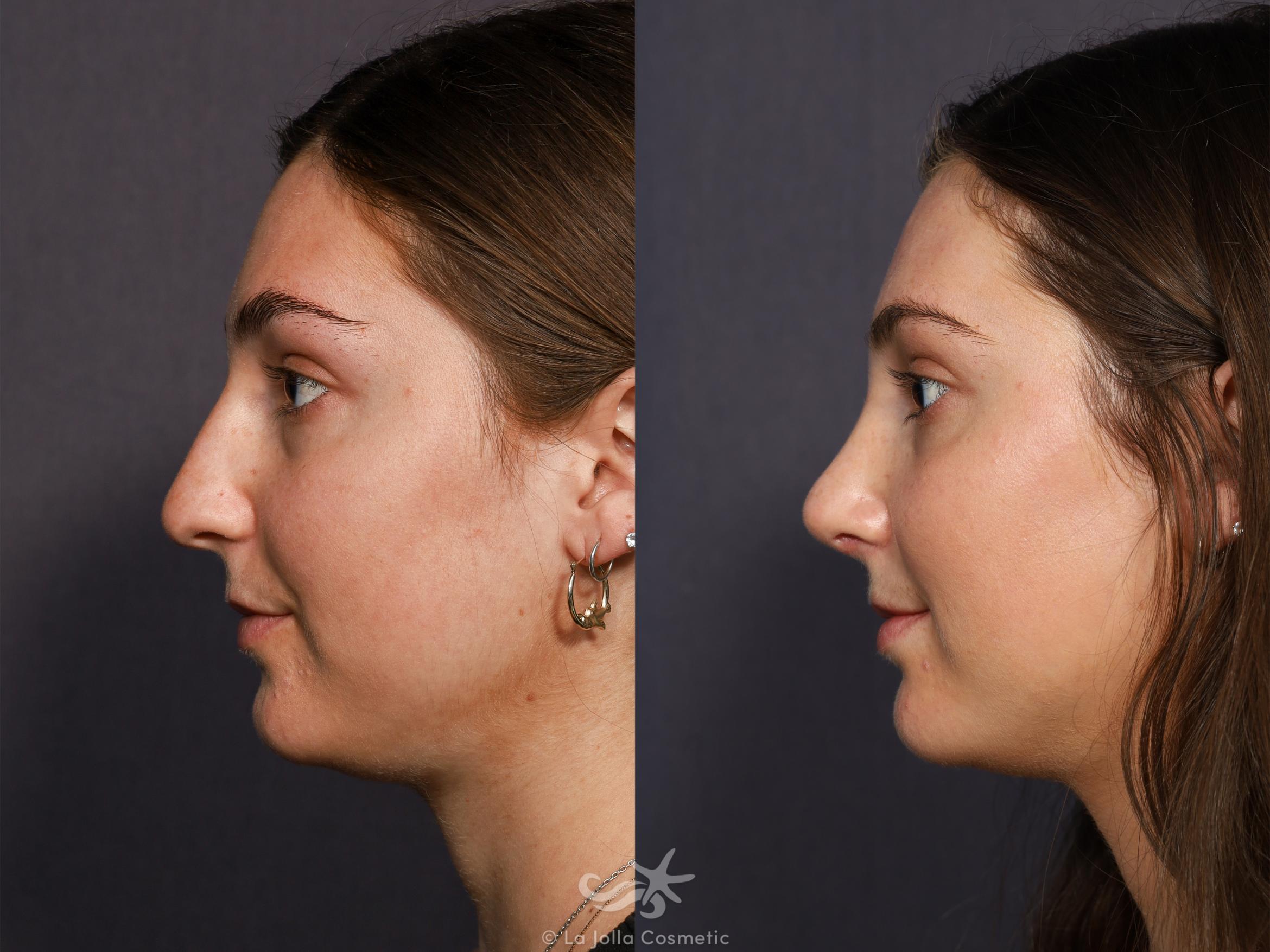 Before & After Rhinoplasty Result 712 Left Side View in San Diego, CA
