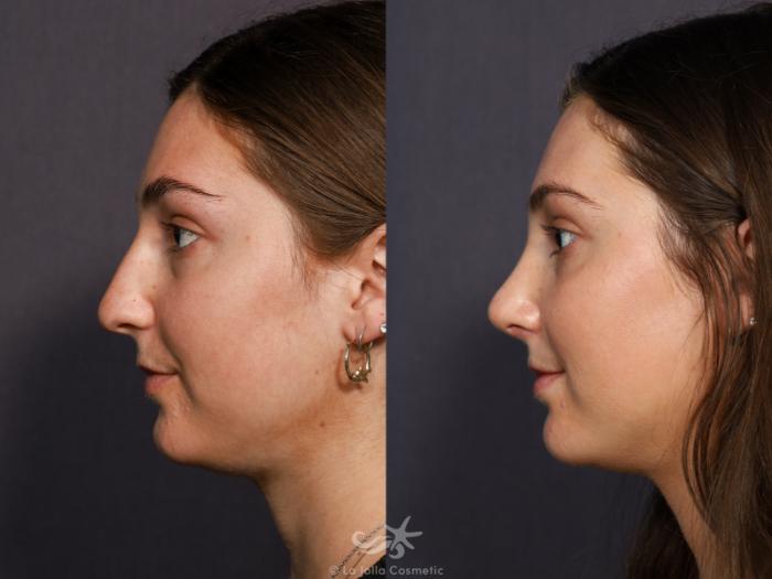 Before & After Rhinoplasty Result 712 Left Side View in San Diego, Carlsbad, CA