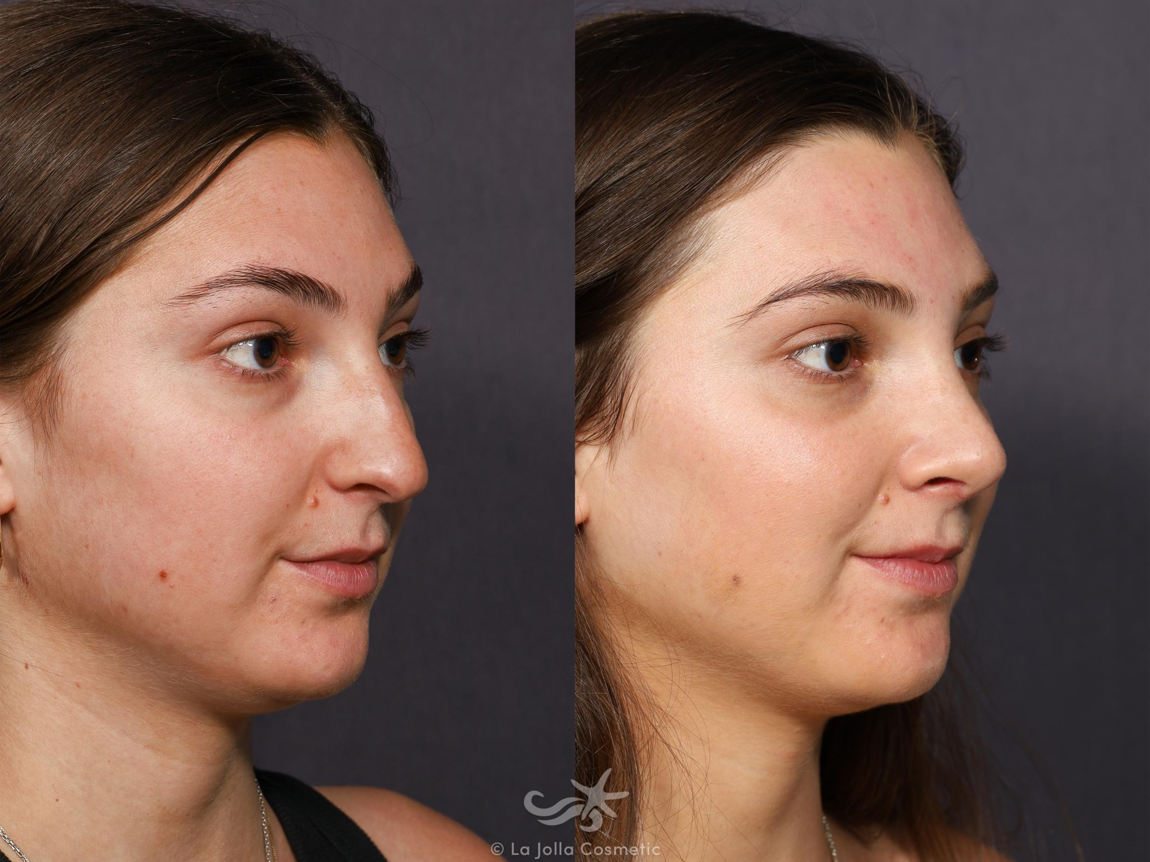 Before & After Rhinoplasty Result 712 Right Oblique View in San Diego, CA