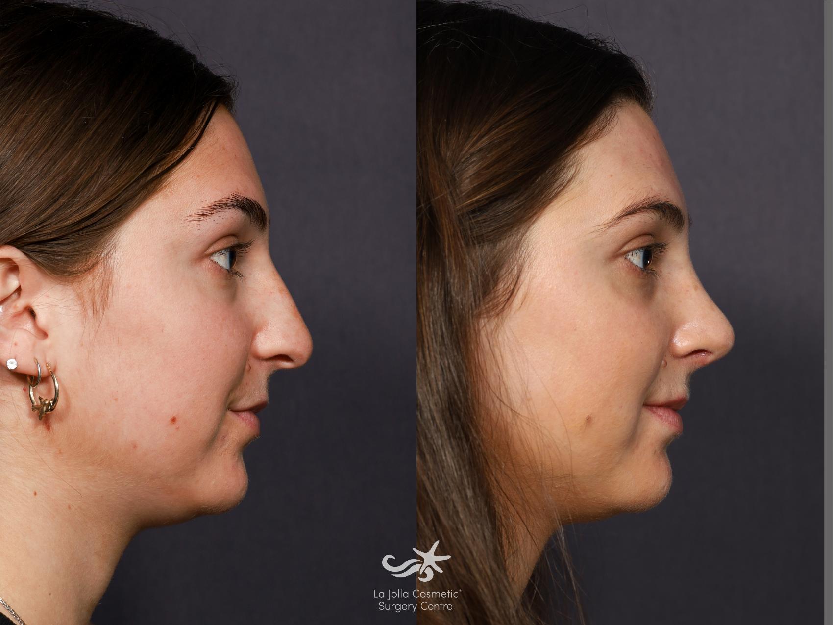 Before & After Rhinoplasty Result 712 Right Side View in San Diego, CA