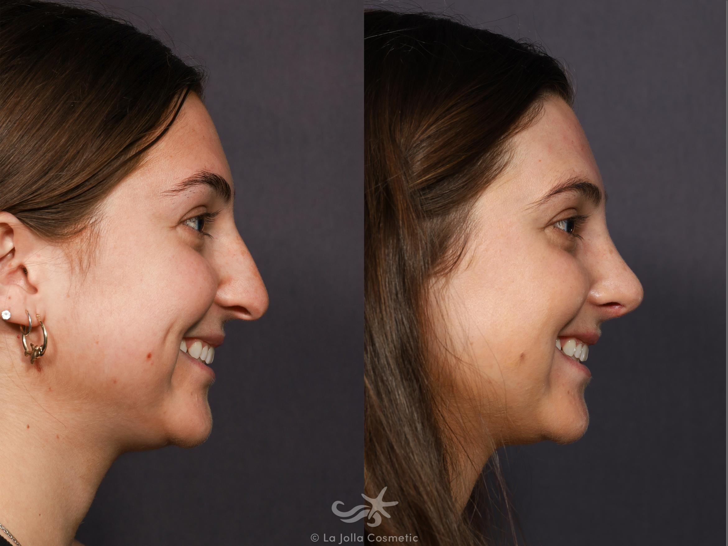 Before & After Rhinoplasty Result 712 Right Side Smiling View in San Diego, CA