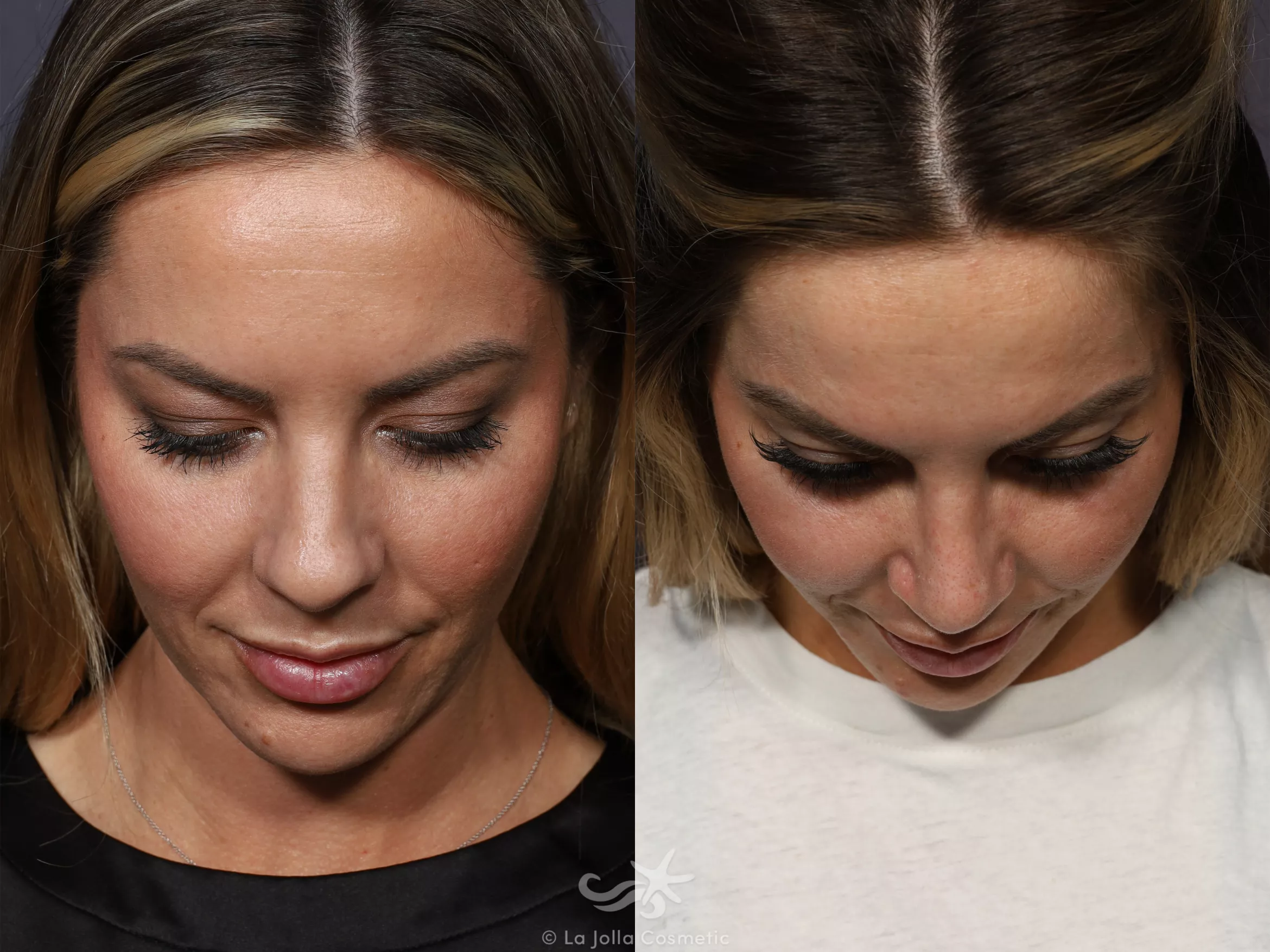 Before & After Rhinoplasty Result 731 Bird's Eye View in San Diego, CA