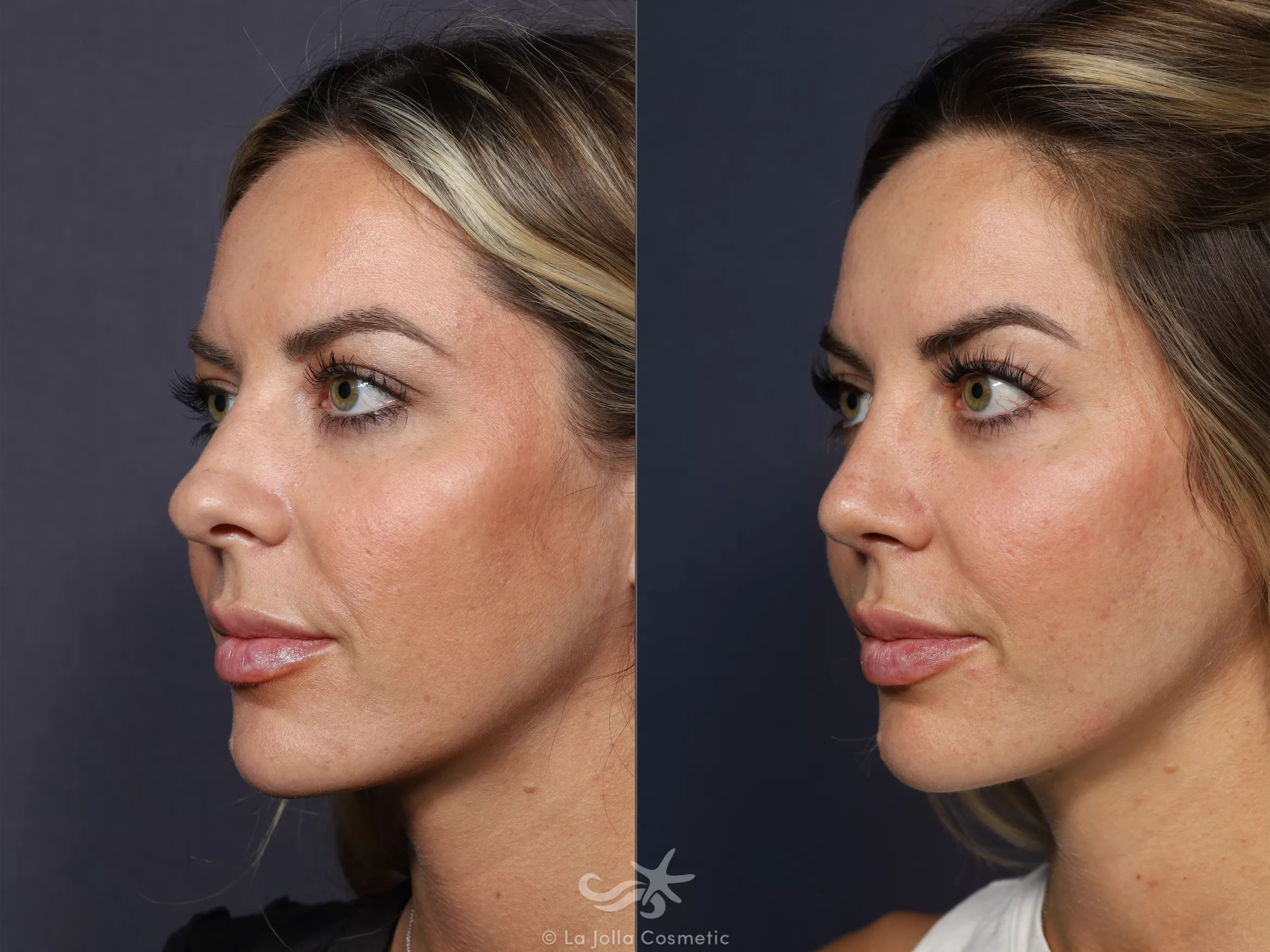 Before & After Rhinoplasty Result 731 Left Oblique View in San Diego, CA