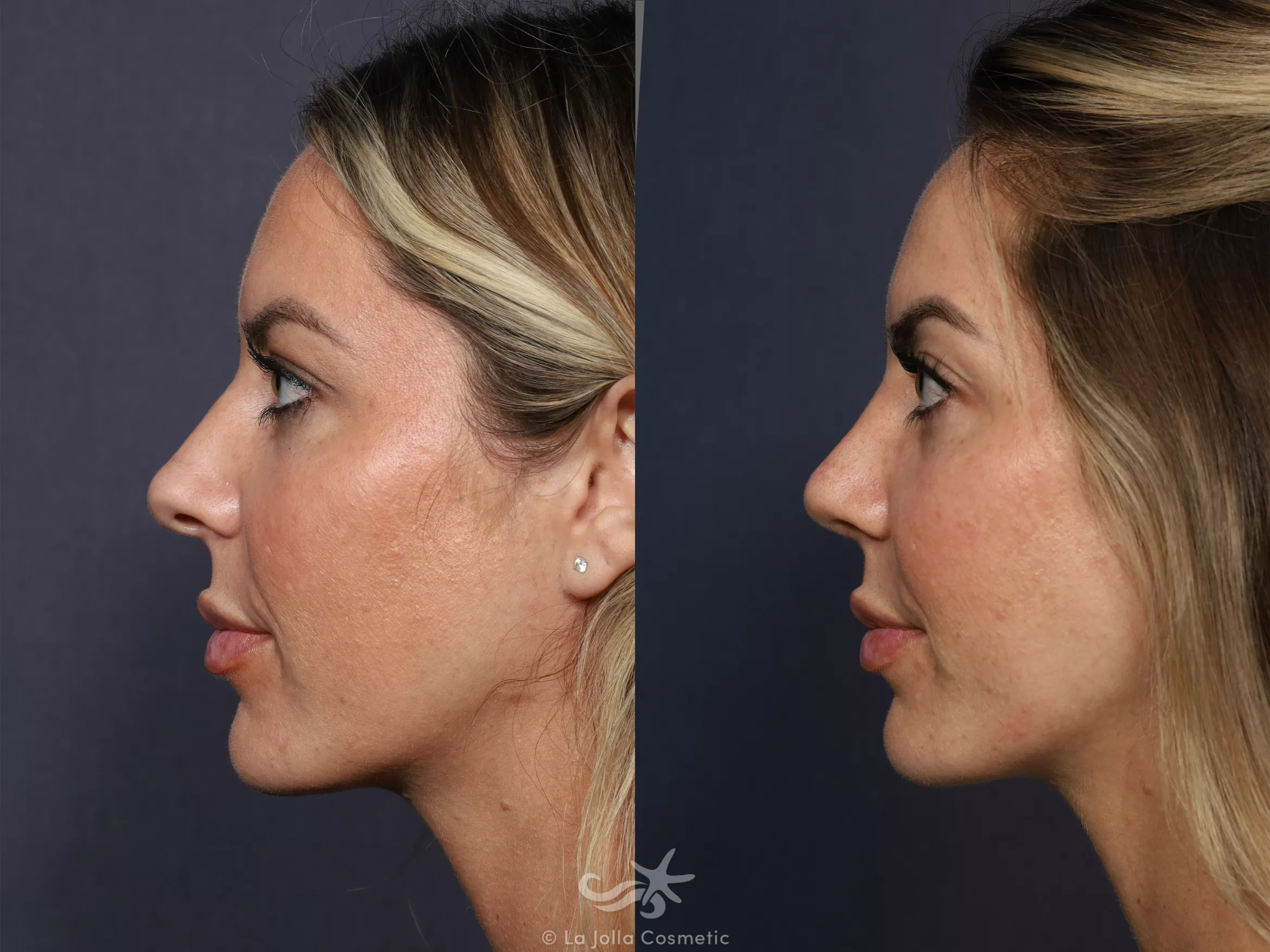 Before & After Rhinoplasty Result 731 Left Side View in San Diego, CA