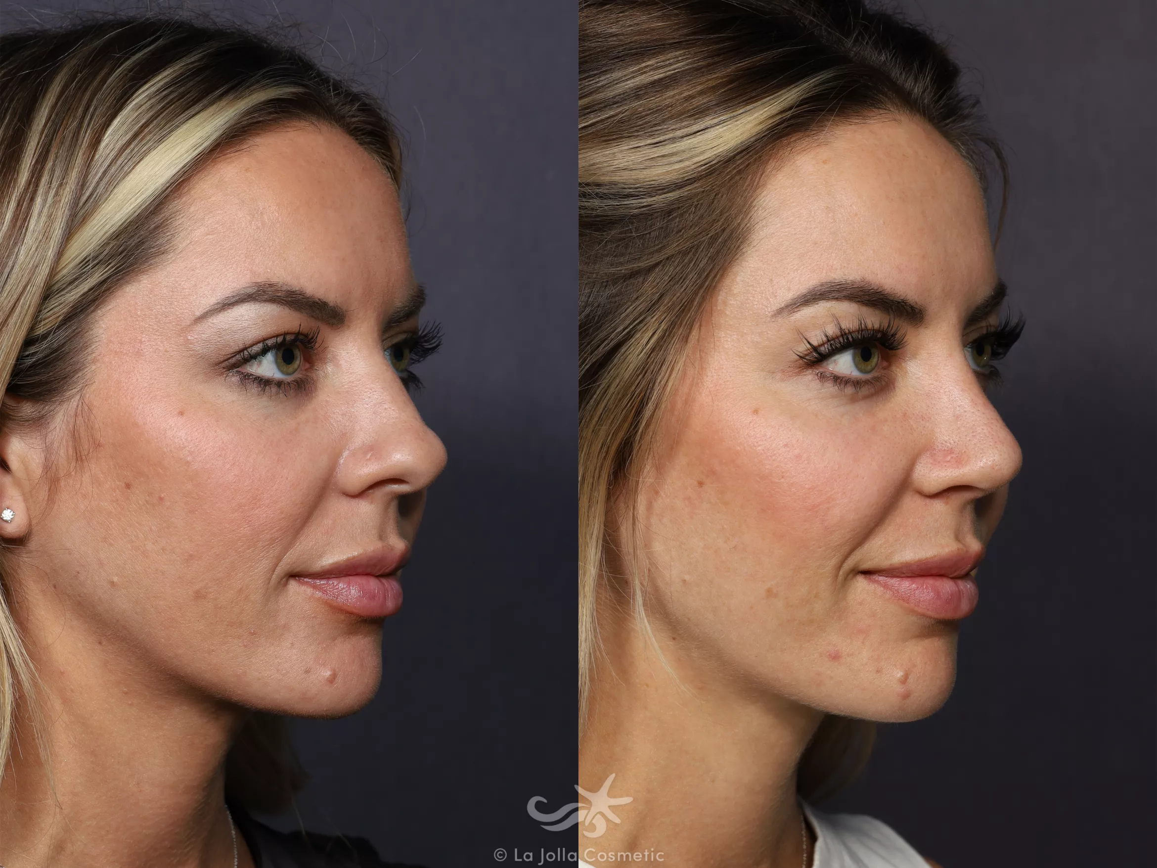 Before & After Rhinoplasty Result 731 Right Oblique View in San Diego, CA
