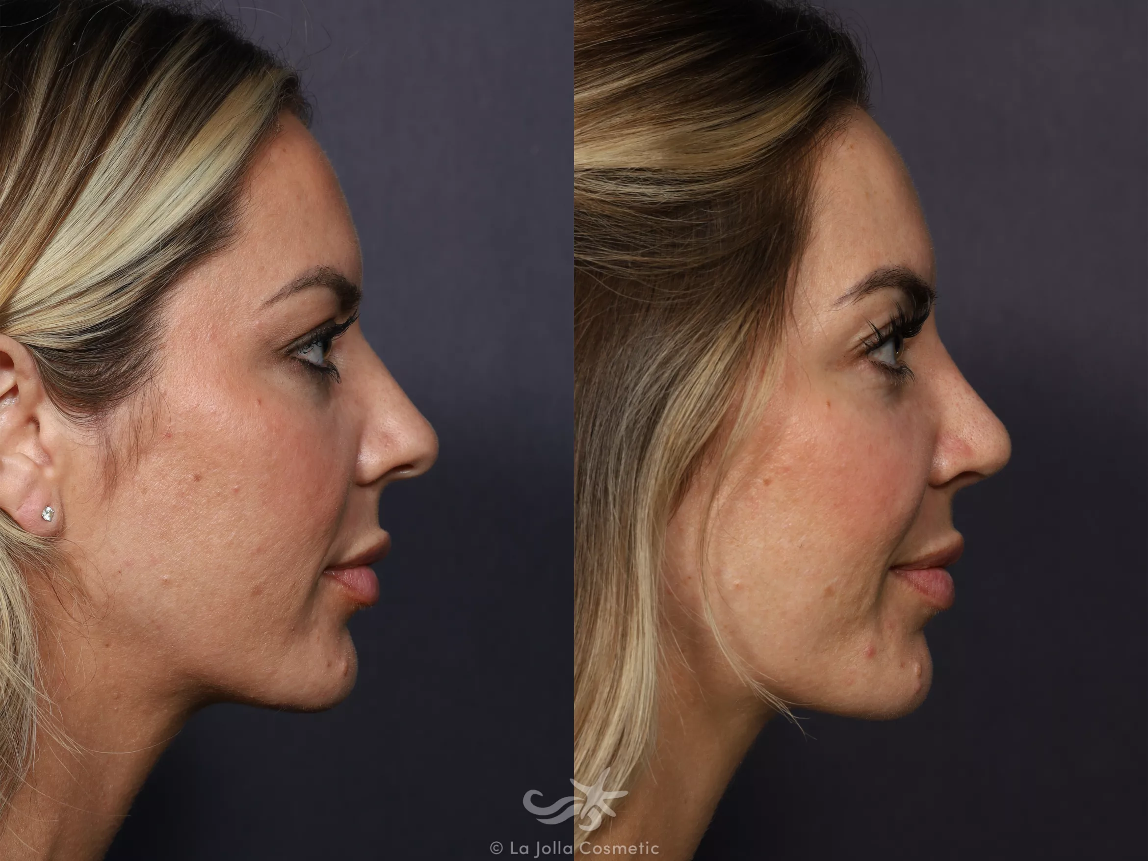 Before & After Rhinoplasty Result 731 Right Side View in San Diego, CA