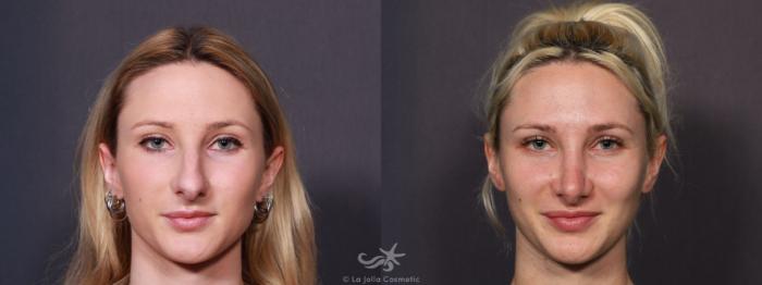 Before & After Rhinoplasty Result 777 Front View in San Diego, Carlsbad, CA