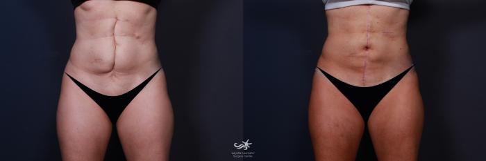 Before & After Scar Treatment Result 183 Front View in San Diego, Carlsbad, CA