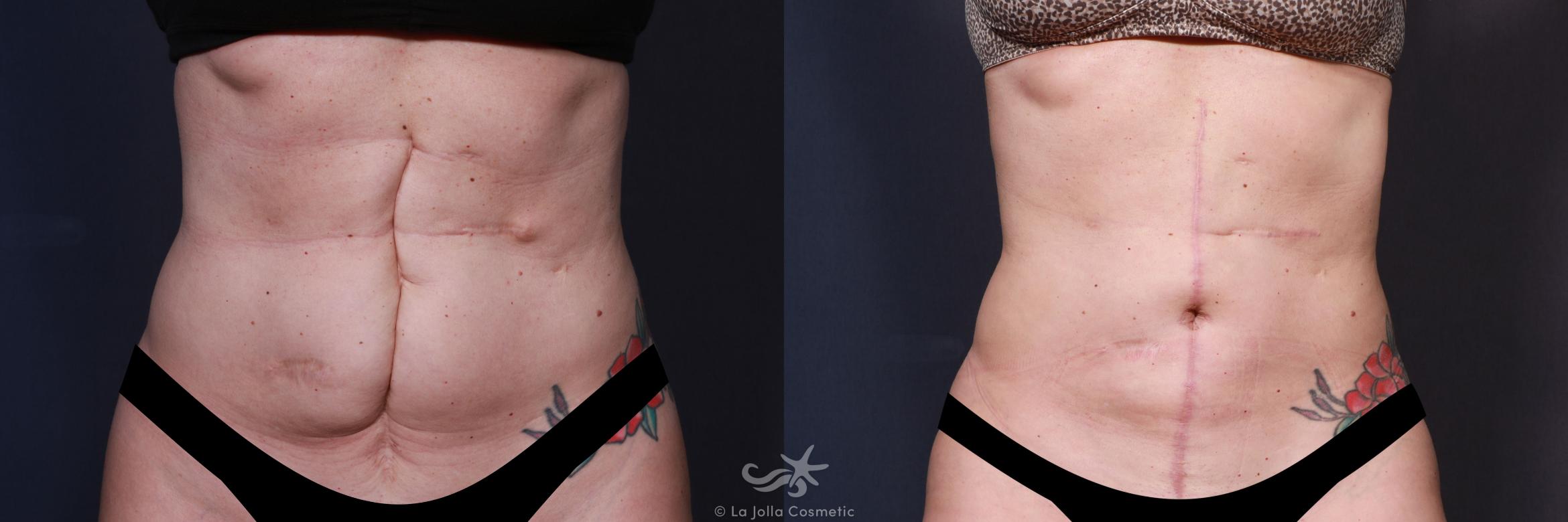 Before & After Scar Treatment Result 650 Front View in San Diego, Carlsbad, CA