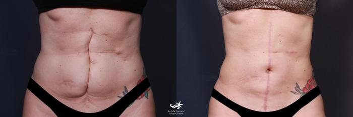 Liposuction Before and After Photo Gallery, San Diego, CA