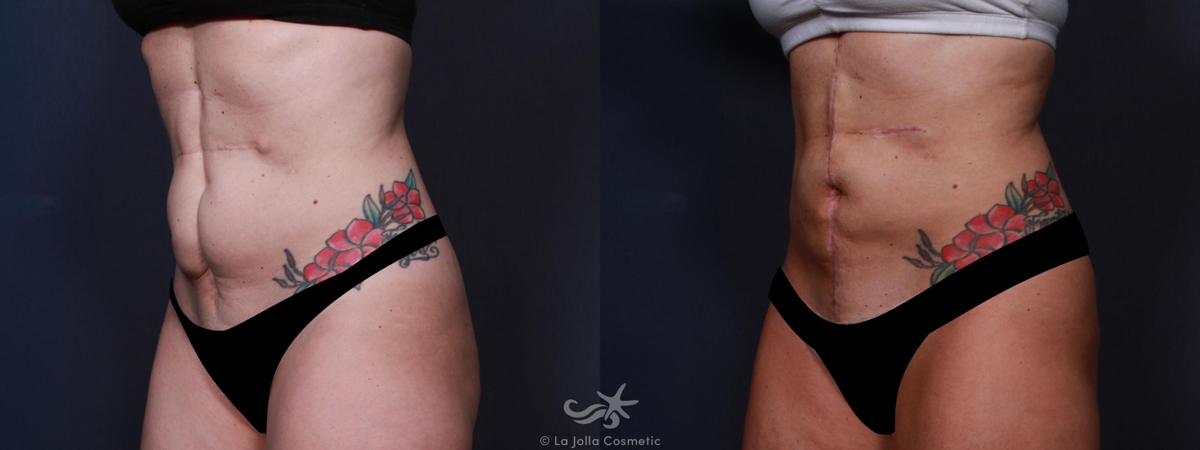 Before & After Scar Treatment Result 650 Left Oblique View in San Diego, CA