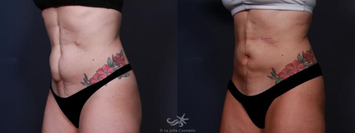 Before & After Scar Treatment Result 650 Left Oblique View in San Diego, Carlsbad, CA