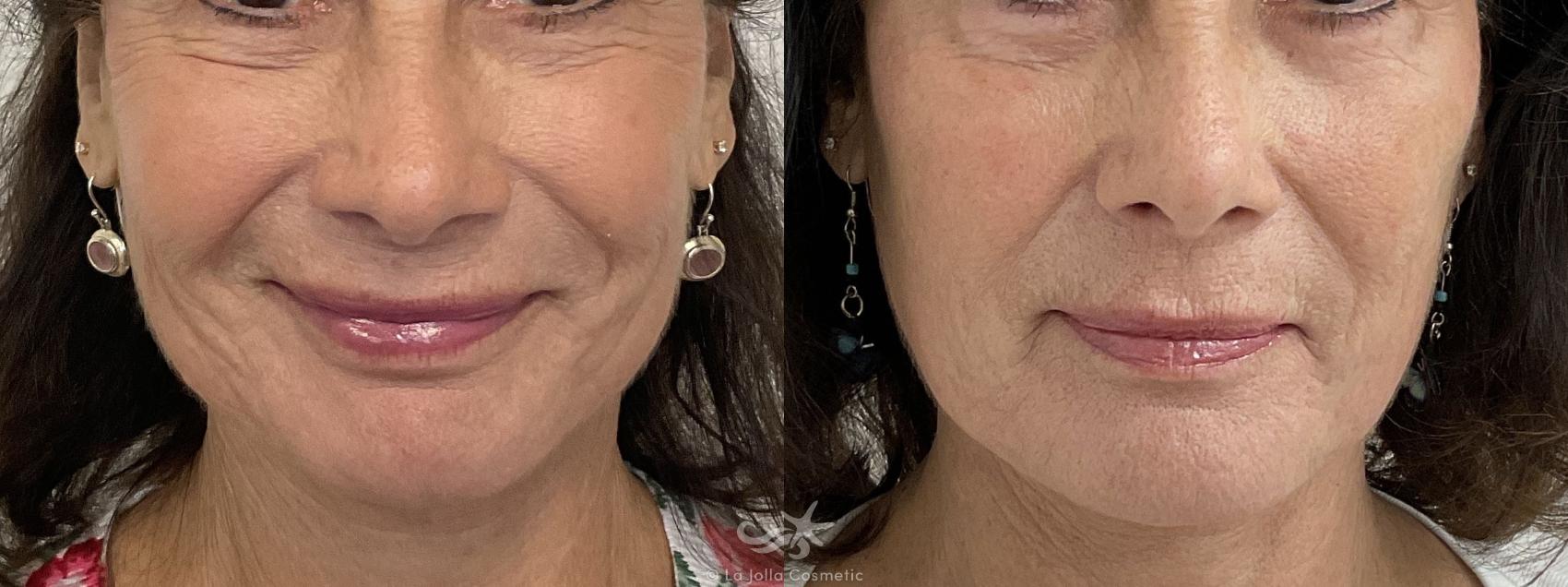 Before & After Sculptra® Result 899 Front View in San Diego, Carlsbad, CA